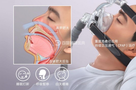 阻塞性睡眠呼吸暂停低通气综合征(睡眠呼吸疾病)