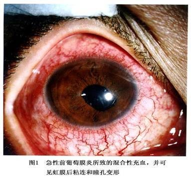 虹膜异色性葡萄膜炎