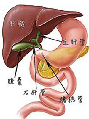 胆总管癌